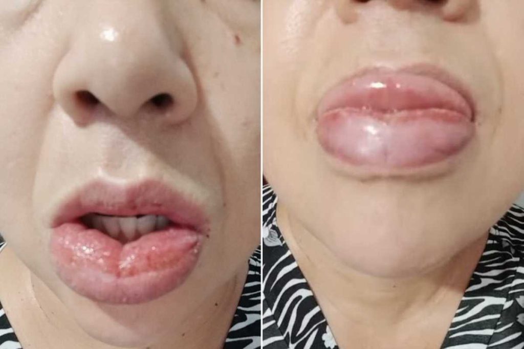 Colgate encerra produção, Reações adversas pasta de dente