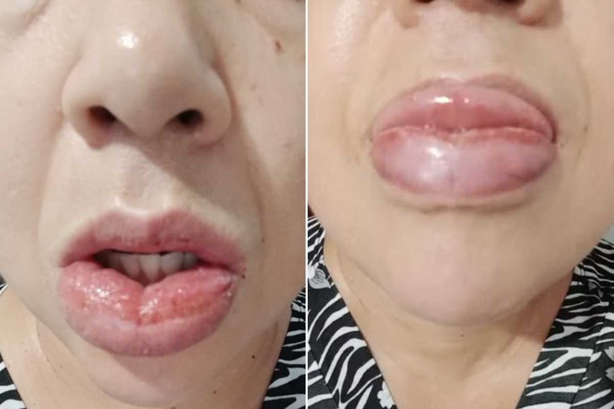 Colgate encerra produção, Reações adversas pasta de dente