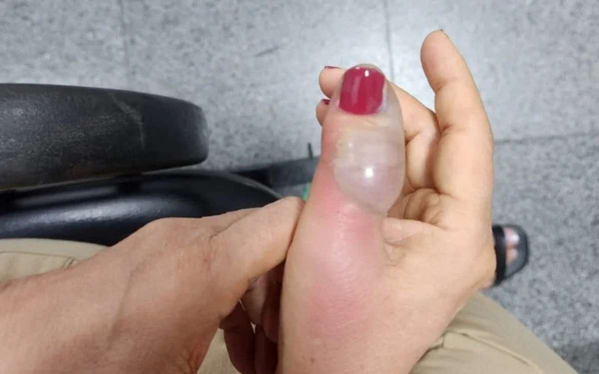 Mulher quase perde dedo e passa por 4 cirurgias após fazer as unhas
