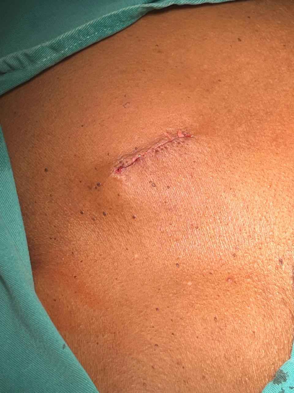 Marcapasso: quando usar, vantagens e especialista atendendo no Litoral 32