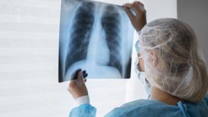 Câncer de pulmão cresce entre não fumantes no RS